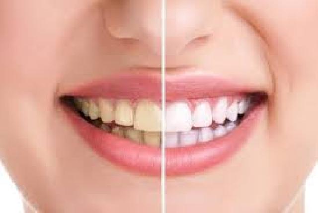 Menghilangkan Plak Gigi Tanpa Harus Mengeluarkan Biaya yang Mahal 